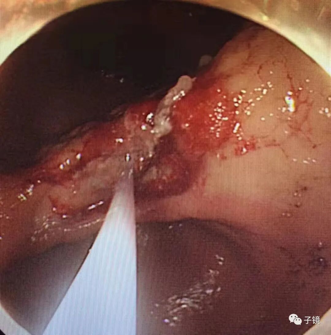 什么是电凝止血“非静脉曲张性消化道出血内镜止血宝典”学习笔记_https://www.jmylbn.com_新闻资讯_第22张