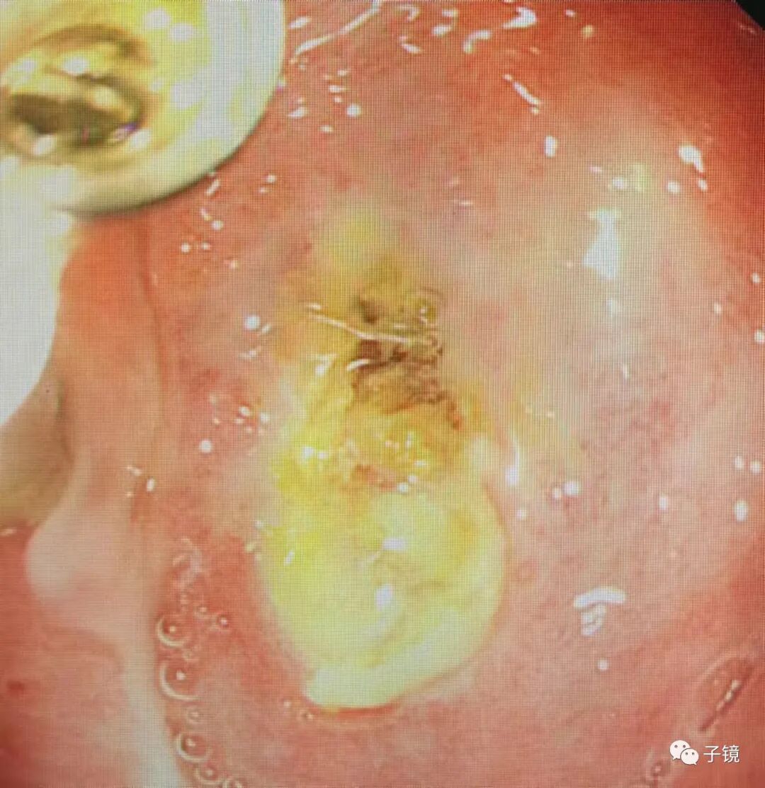 什么是电凝止血“非静脉曲张性消化道出血内镜止血宝典”学习笔记_https://www.jmylbn.com_新闻资讯_第23张