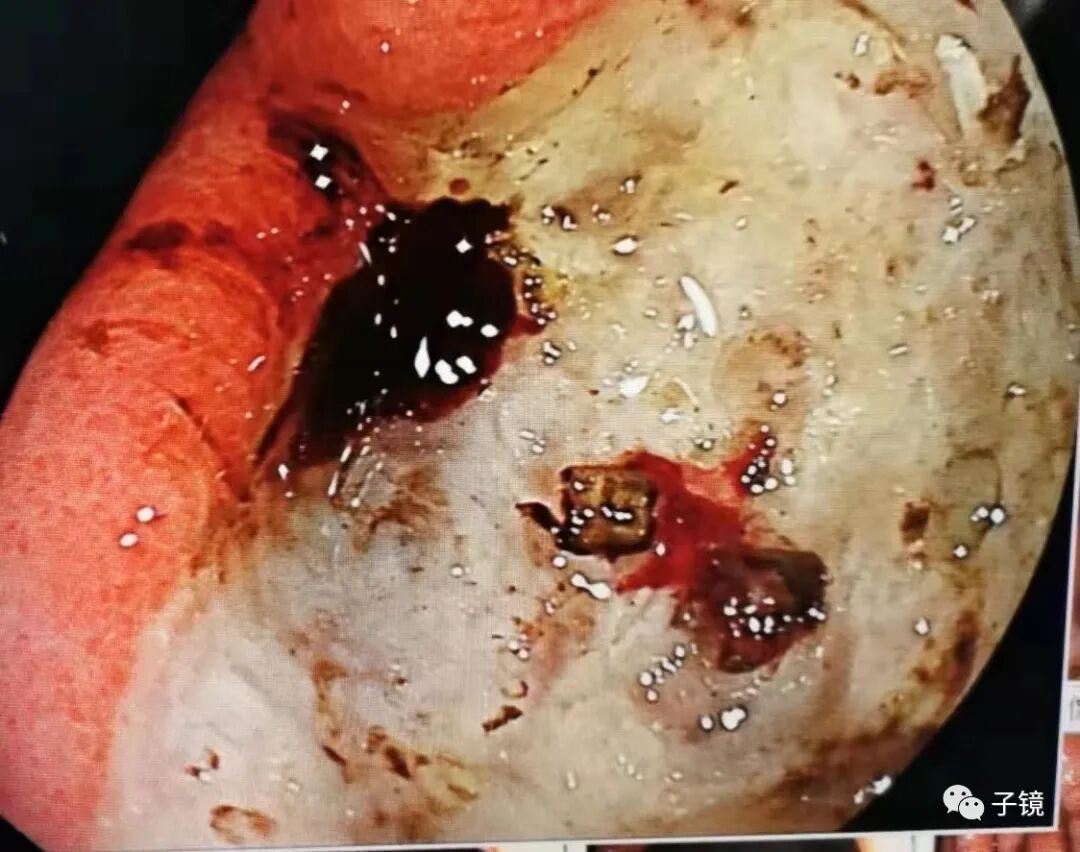 什么是电凝止血“非静脉曲张性消化道出血内镜止血宝典”学习笔记_https://www.jmylbn.com_新闻资讯_第13张