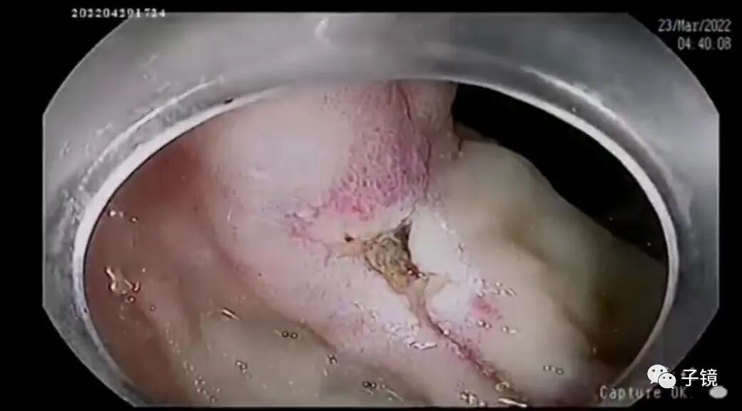 什么是电凝止血“非静脉曲张性消化道出血内镜止血宝典”学习笔记_https://www.jmylbn.com_新闻资讯_第9张