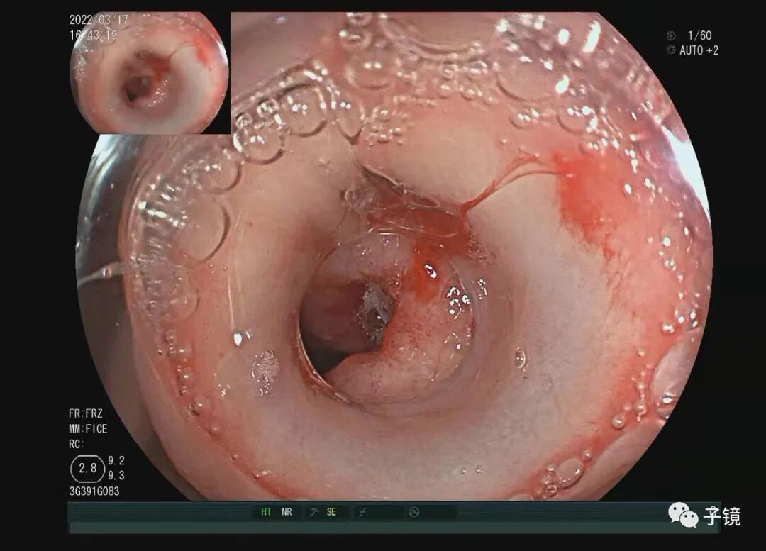 什么是电凝止血“非静脉曲张性消化道出血内镜止血宝典”学习笔记_https://www.jmylbn.com_新闻资讯_第12张
