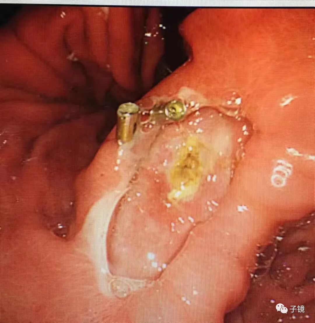 什么是电凝止血“非静脉曲张性消化道出血内镜止血宝典”学习笔记_https://www.jmylbn.com_新闻资讯_第24张