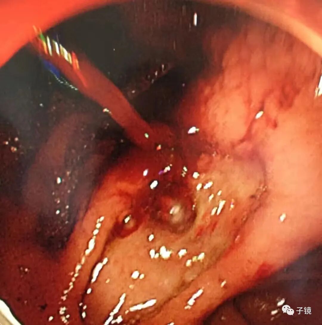 什么是电凝止血“非静脉曲张性消化道出血内镜止血宝典”学习笔记_https://www.jmylbn.com_新闻资讯_第21张