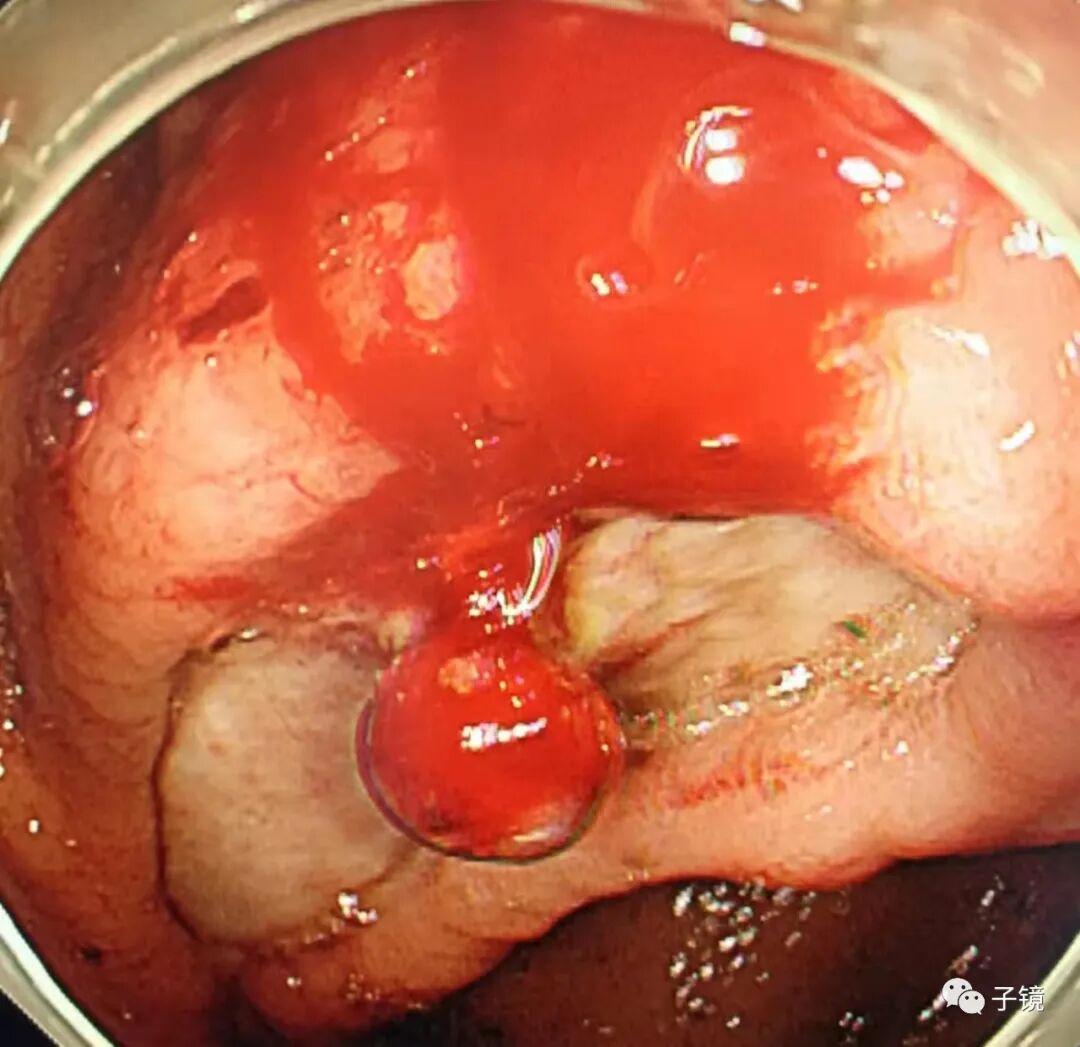 什么是电凝止血“非静脉曲张性消化道出血内镜止血宝典”学习笔记_https://www.jmylbn.com_新闻资讯_第20张