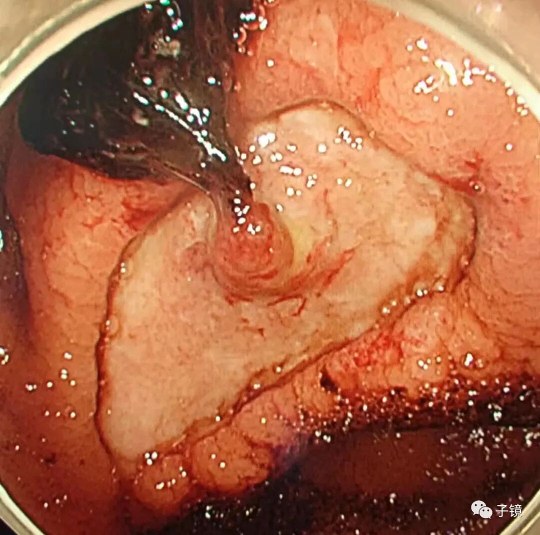 什么是电凝止血“非静脉曲张性消化道出血内镜止血宝典”学习笔记_https://www.jmylbn.com_新闻资讯_第18张