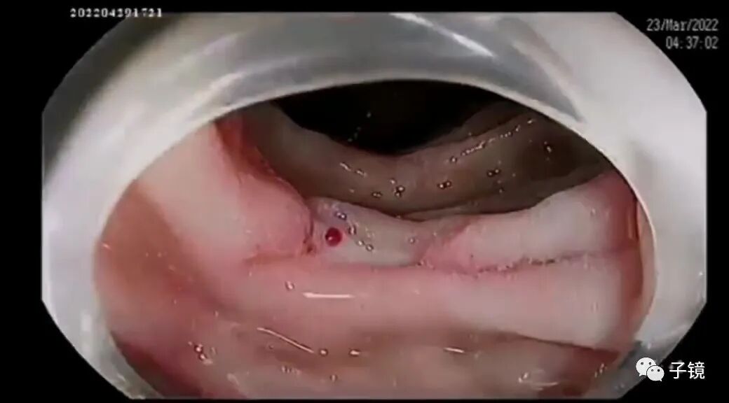 什么是电凝止血“非静脉曲张性消化道出血内镜止血宝典”学习笔记_https://www.jmylbn.com_新闻资讯_第1张