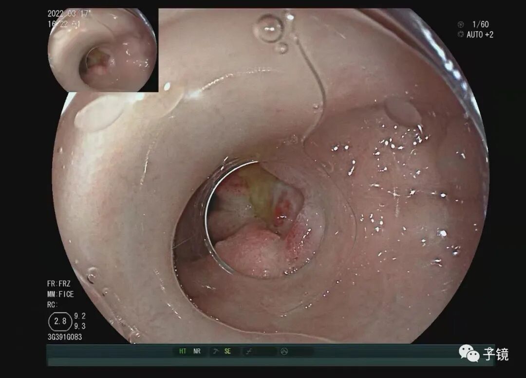 什么是电凝止血“非静脉曲张性消化道出血内镜止血宝典”学习笔记_https://www.jmylbn.com_新闻资讯_第10张