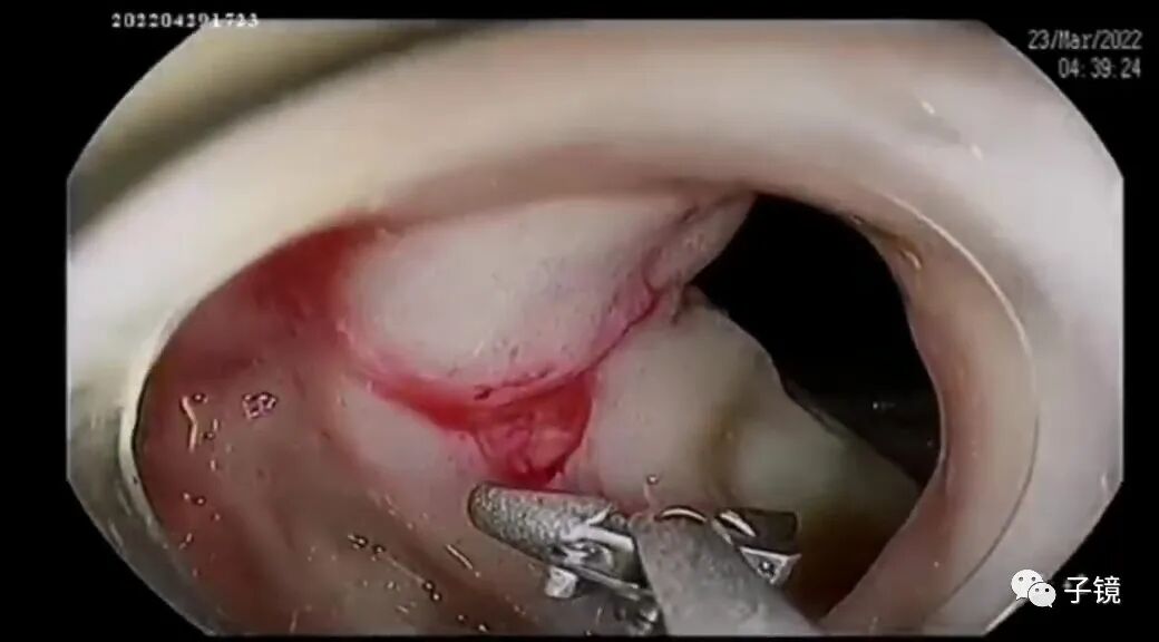 什么是电凝止血“非静脉曲张性消化道出血内镜止血宝典”学习笔记_https://www.jmylbn.com_新闻资讯_第6张