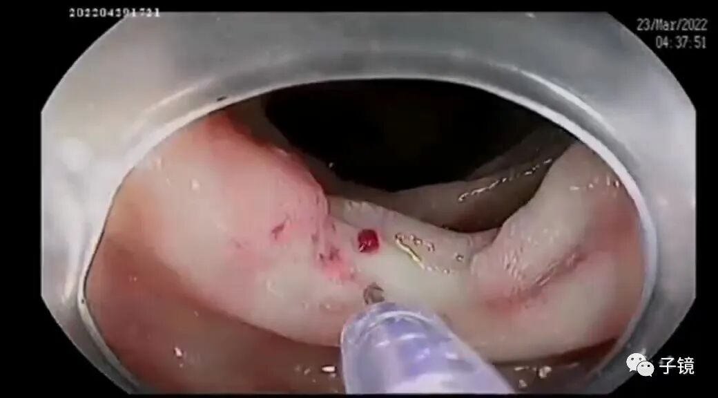 什么是电凝止血“非静脉曲张性消化道出血内镜止血宝典”学习笔记_https://www.jmylbn.com_新闻资讯_第2张