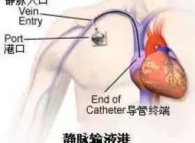 化疗泵怎么装肿瘤内科有话说｜反复输液太痛苦，不妨安装“输液港”_https://www.jmylbn.com_新闻资讯_第13张
