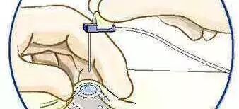 化疗泵怎么装肿瘤内科有话说｜反复输液太痛苦，不妨安装“输液港”_https://www.jmylbn.com_新闻资讯_第11张