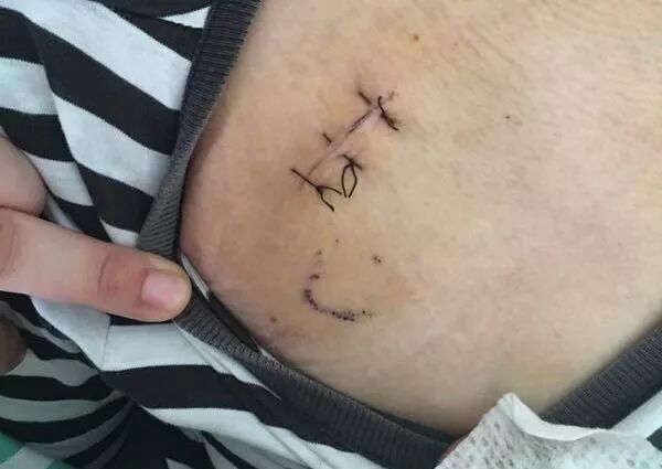 化疗泵怎么装肿瘤内科有话说｜反复输液太痛苦，不妨安装“输液港”_https://www.jmylbn.com_新闻资讯_第12张