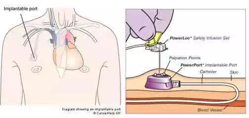 化疗泵怎么装肿瘤内科有话说｜反复输液太痛苦，不妨安装“输液港”_https://www.jmylbn.com_新闻资讯_第10张