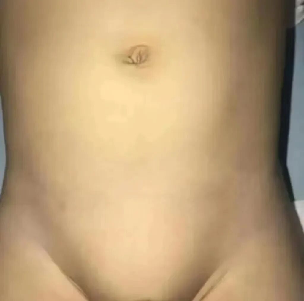 怎么制造手术钩针小儿疝气如何治疗？“针”“疝”“美”来了解一下吧！_https://www.jmylbn.com_新闻资讯_第8张