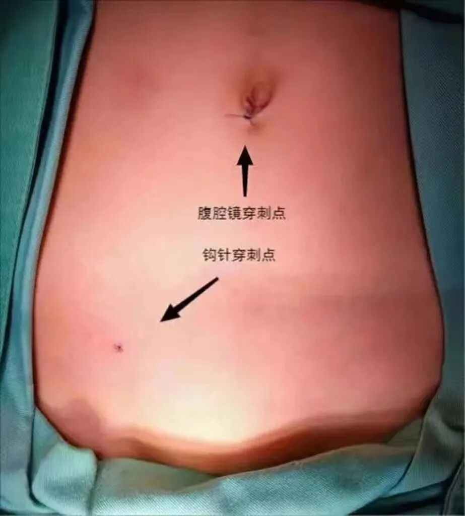 怎么制造手术钩针小儿疝气如何治疗？“针”“疝”“美”来了解一下吧！_https://www.jmylbn.com_新闻资讯_第7张