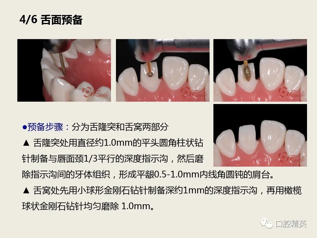 烤瓷牙为什么那么可怕？做烤瓷牙的人后来都怎么样了？ - 知乎