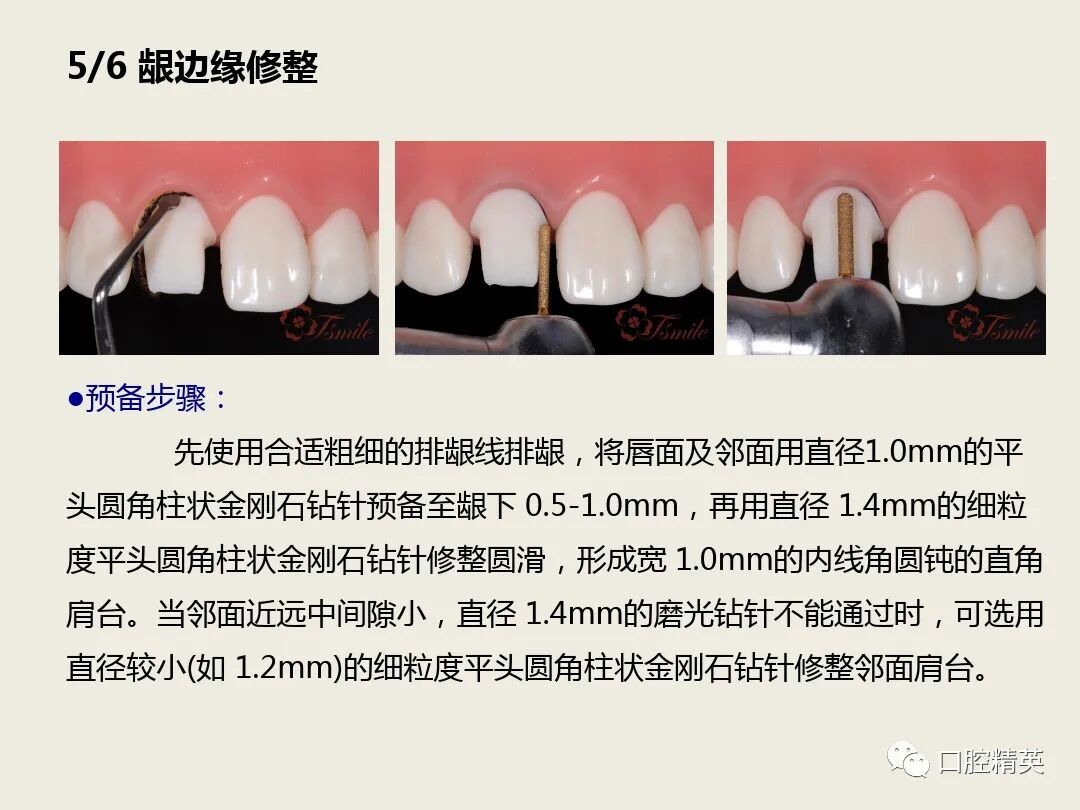 烤瓷牙为什么那么可怕？做烤瓷牙的人后来都怎么样了？ - 知乎