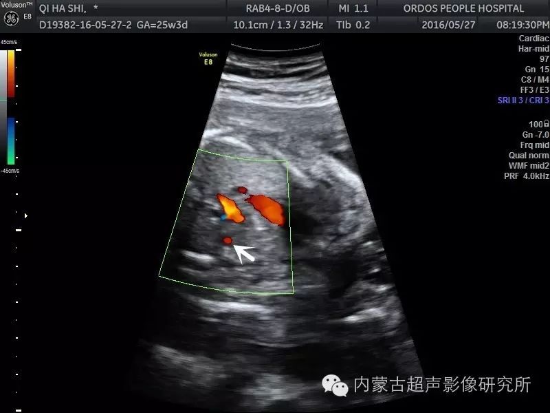 心脏冠状静脉窦超声图图片
