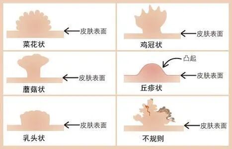 Std 皮肤之花 尖锐湿疣的正经科普 上海青艾皮肤科诊所