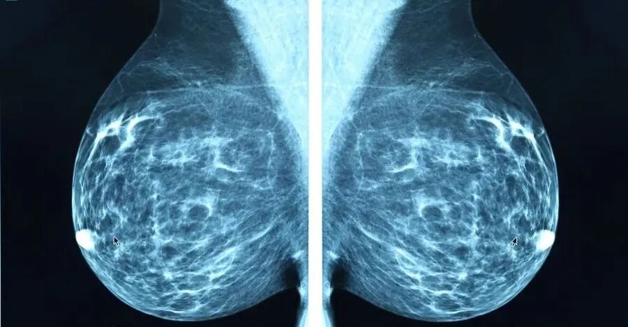 乳腺机为什么叫钼靶钼靶，大家都说“痛”，但是，为什么都争先去做呢？这背后隐藏着什么？_https://www.jmylbn.com_新闻资讯_第7张