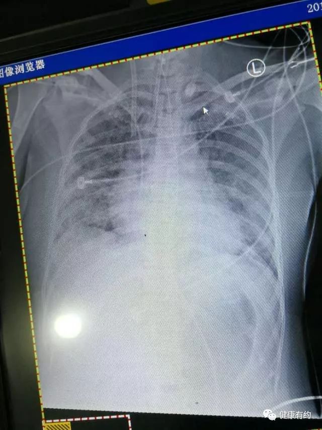 广州女子感冒6天后竟进了ICU！花了几十万，数闯鬼门关，过程超级凶险！