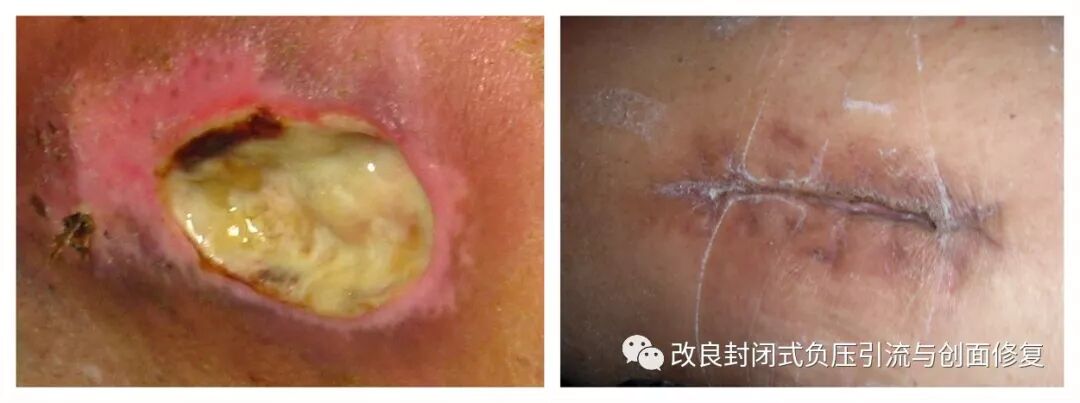 VSD怎么更换引流瓶简易封闭式负压引流：操作流程细节，视频配解说_https://www.jmylbn.com_新闻资讯_第8张