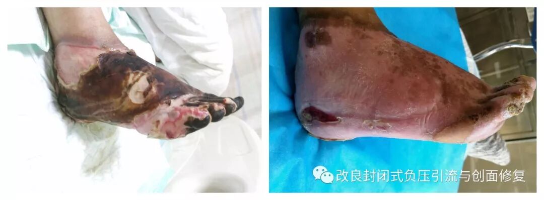 VSD怎么更换引流瓶简易封闭式负压引流：操作流程细节，视频配解说_https://www.jmylbn.com_新闻资讯_第7张