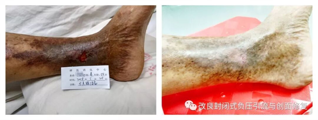 VSD怎么更换引流瓶简易封闭式负压引流：操作流程细节，视频配解说_https://www.jmylbn.com_新闻资讯_第9张