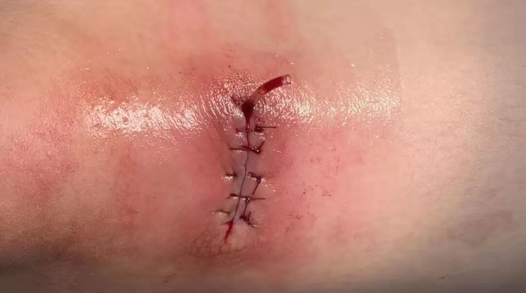 缝合怎么换药换药20多天未愈合的伤口，继续换药or缝合？_https://www.jmylbn.com_新闻资讯_第6张