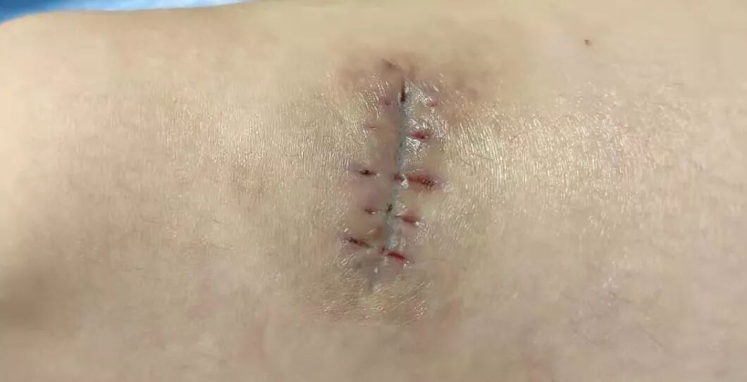 缝合怎么换药换药20多天未愈合的伤口，继续换药or缝合？_https://www.jmylbn.com_新闻资讯_第10张