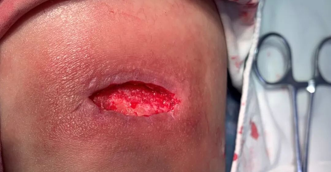 缝合怎么换药换药20多天未愈合的伤口，继续换药or缝合？_https://www.jmylbn.com_新闻资讯_第5张