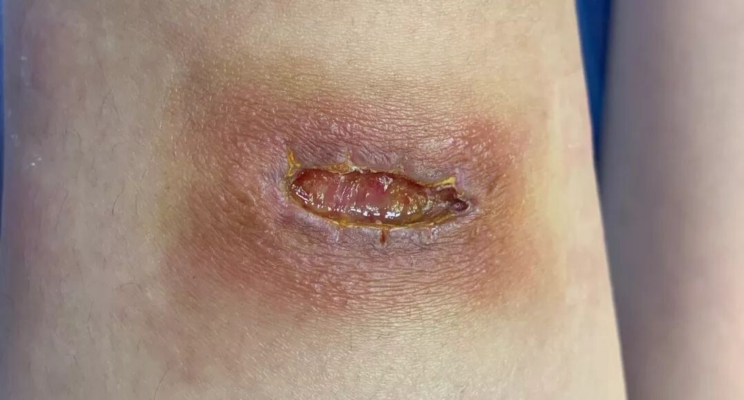 缝合怎么换药换药20多天未愈合的伤口，继续换药or缝合？_https://www.jmylbn.com_新闻资讯_第2张