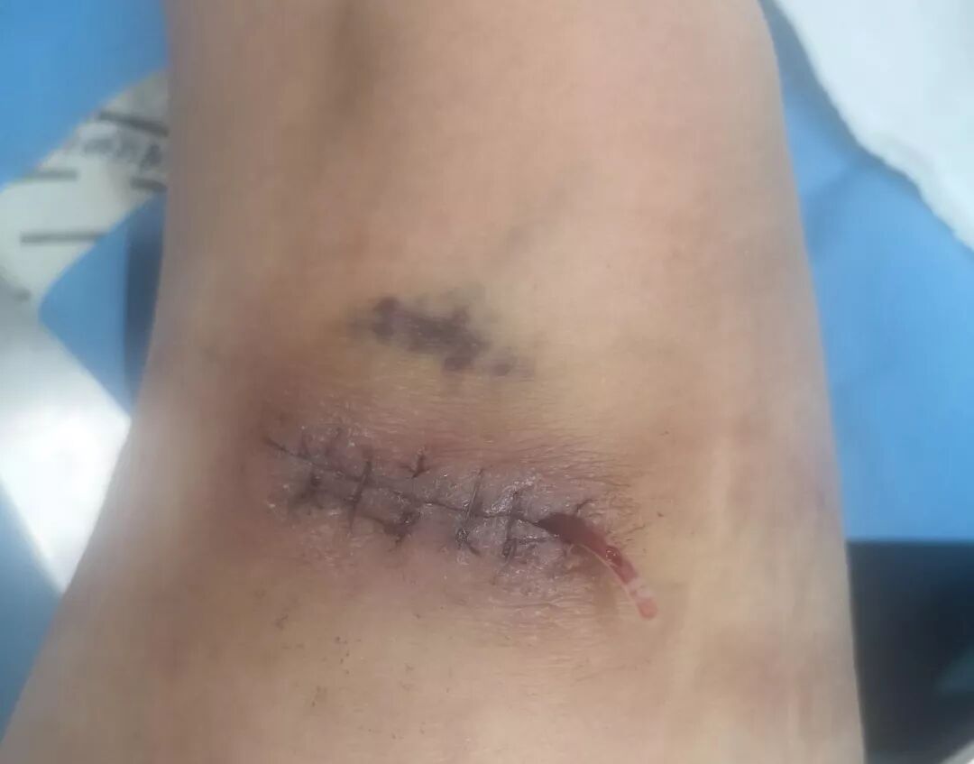 缝合怎么换药换药20多天未愈合的伤口，继续换药or缝合？_https://www.jmylbn.com_新闻资讯_第8张