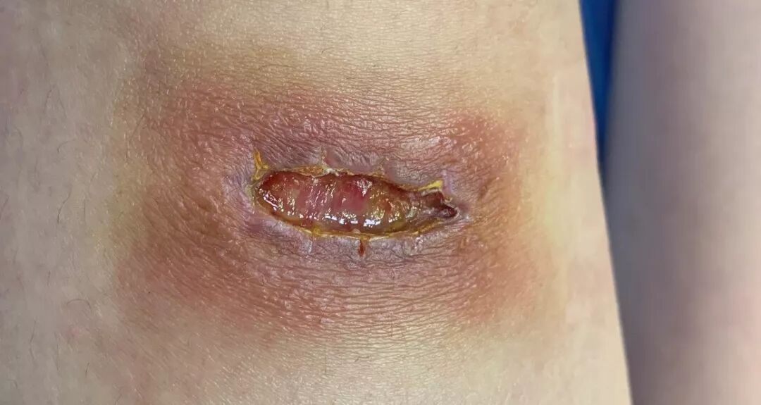 缝合怎么换药换药20多天未愈合的伤口，继续换药or缝合？_https://www.jmylbn.com_新闻资讯_第3张