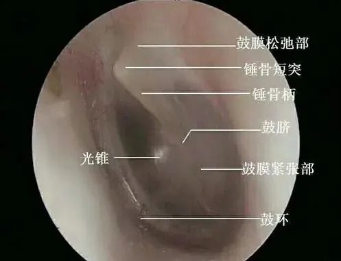 鼓膜穿孔了自愈還是手術修補聽聽專家怎麼說