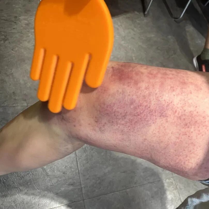 拍打出的痧是什么？出痧的颜色和症状！