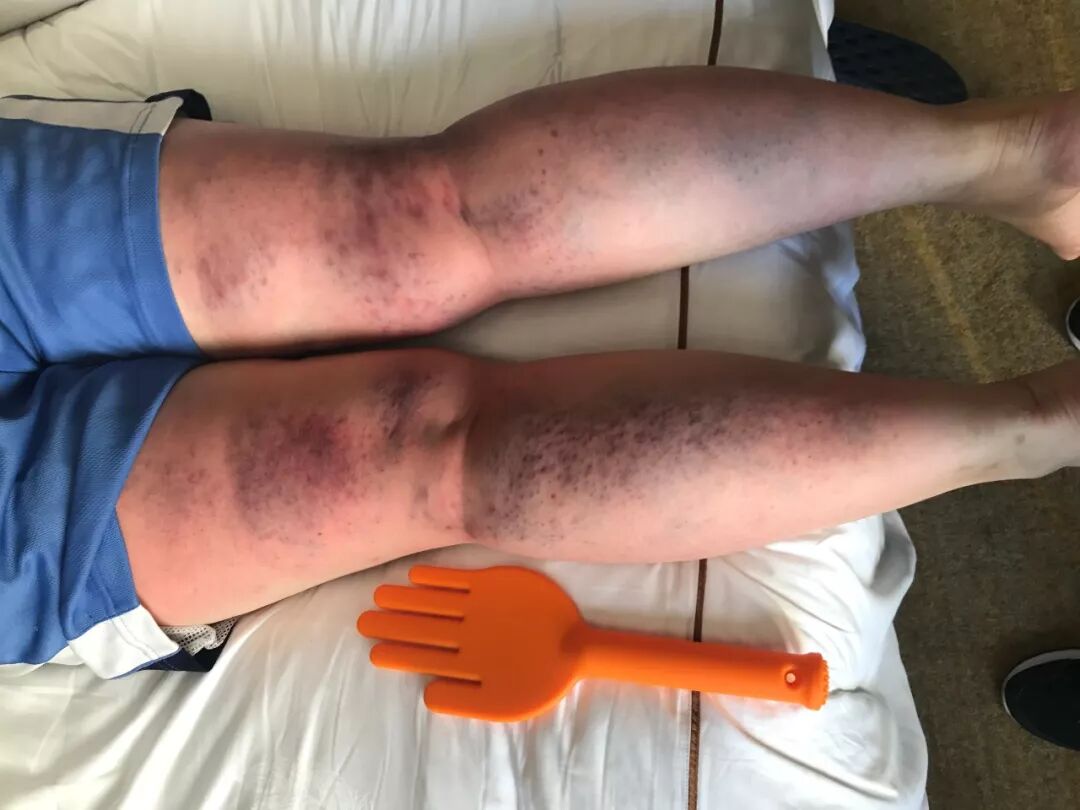 如何理解拍痧出痧的实质 不是毛细血管拍破了