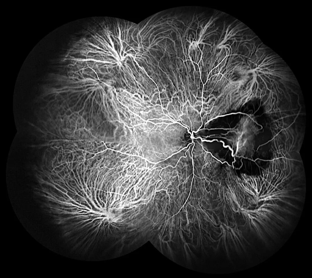 彩色眼底照相查什么眼底“侦察兵”上线！平湖一院眼科新增广角眼底激光相机_https://www.jmylbn.com_新闻资讯_第20张