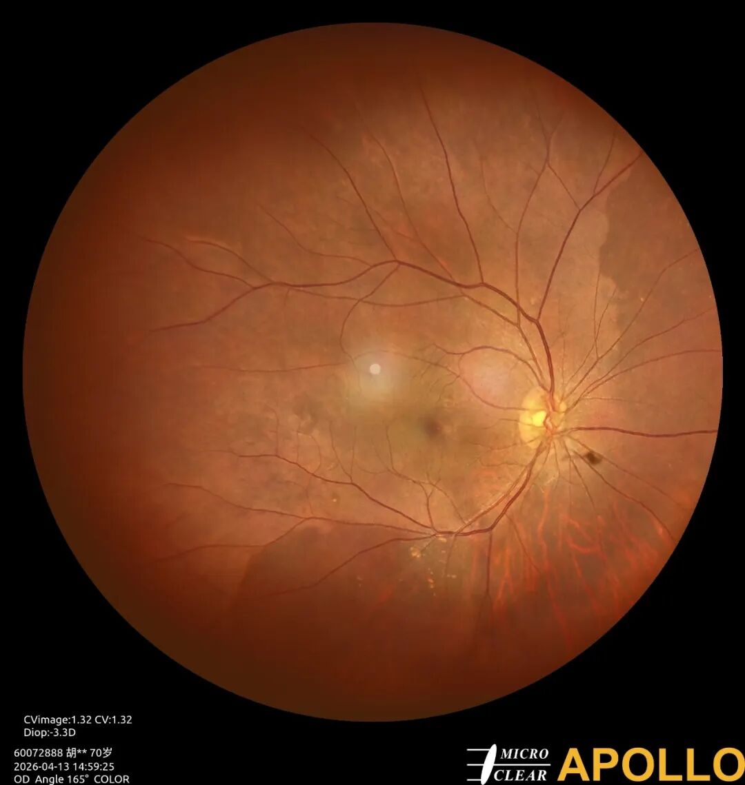 彩色眼底照相查什么眼底“侦察兵”上线！平湖一院眼科新增广角眼底激光相机_https://www.jmylbn.com_新闻资讯_第7张