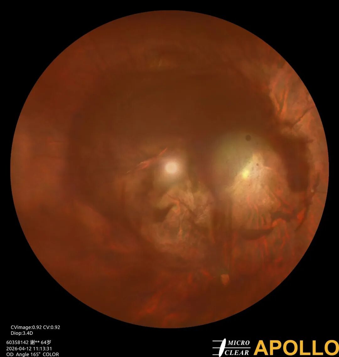 彩色眼底照相查什么眼底“侦察兵”上线！平湖一院眼科新增广角眼底激光相机_https://www.jmylbn.com_新闻资讯_第15张