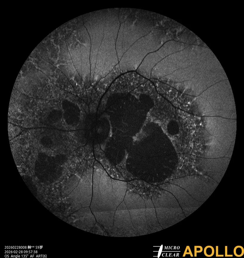 彩色眼底照相查什么眼底“侦察兵”上线！平湖一院眼科新增广角眼底激光相机_https://www.jmylbn.com_新闻资讯_第13张