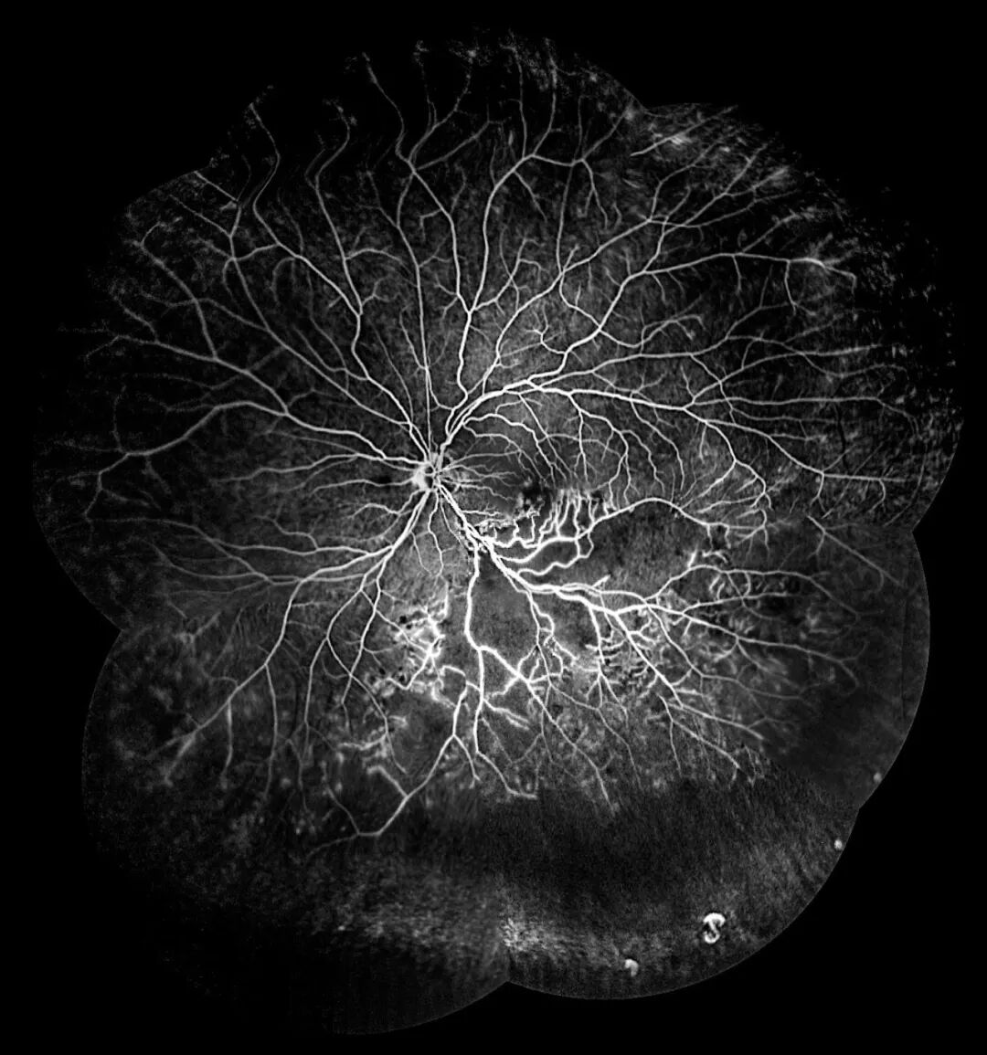 彩色眼底照相查什么眼底“侦察兵”上线！平湖一院眼科新增广角眼底激光相机_https://www.jmylbn.com_新闻资讯_第21张