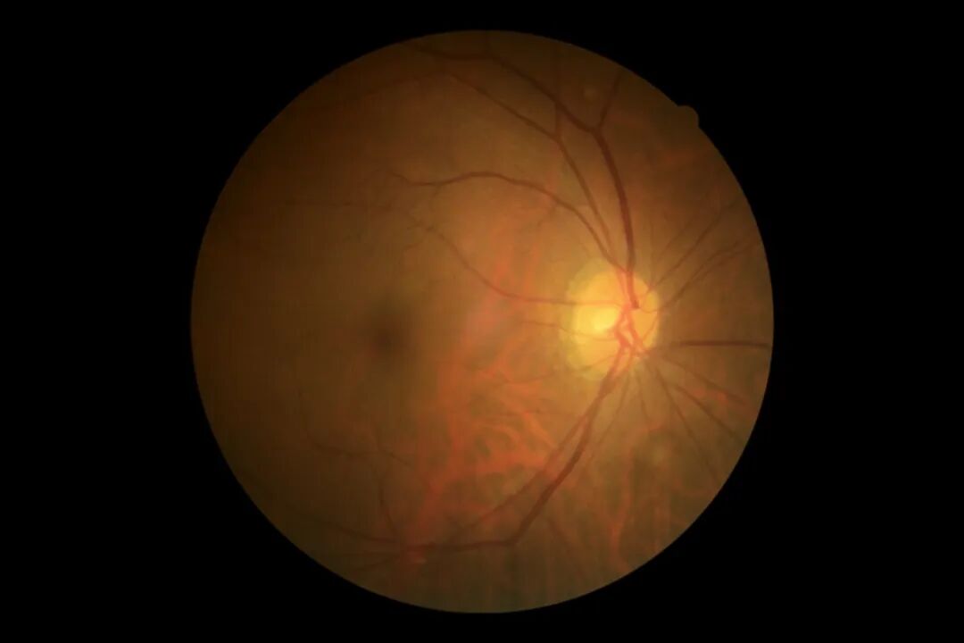 彩色眼底照相查什么眼底“侦察兵”上线！平湖一院眼科新增广角眼底激光相机_https://www.jmylbn.com_新闻资讯_第8张