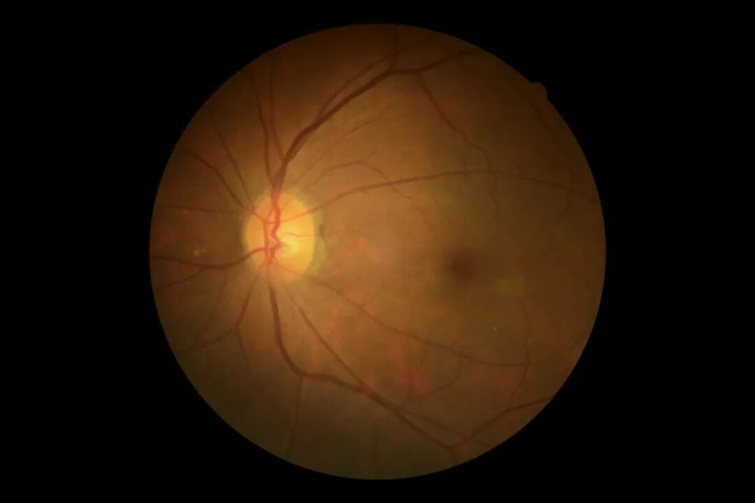 彩色眼底照相查什么眼底“侦察兵”上线！平湖一院眼科新增广角眼底激光相机_https://www.jmylbn.com_新闻资讯_第9张