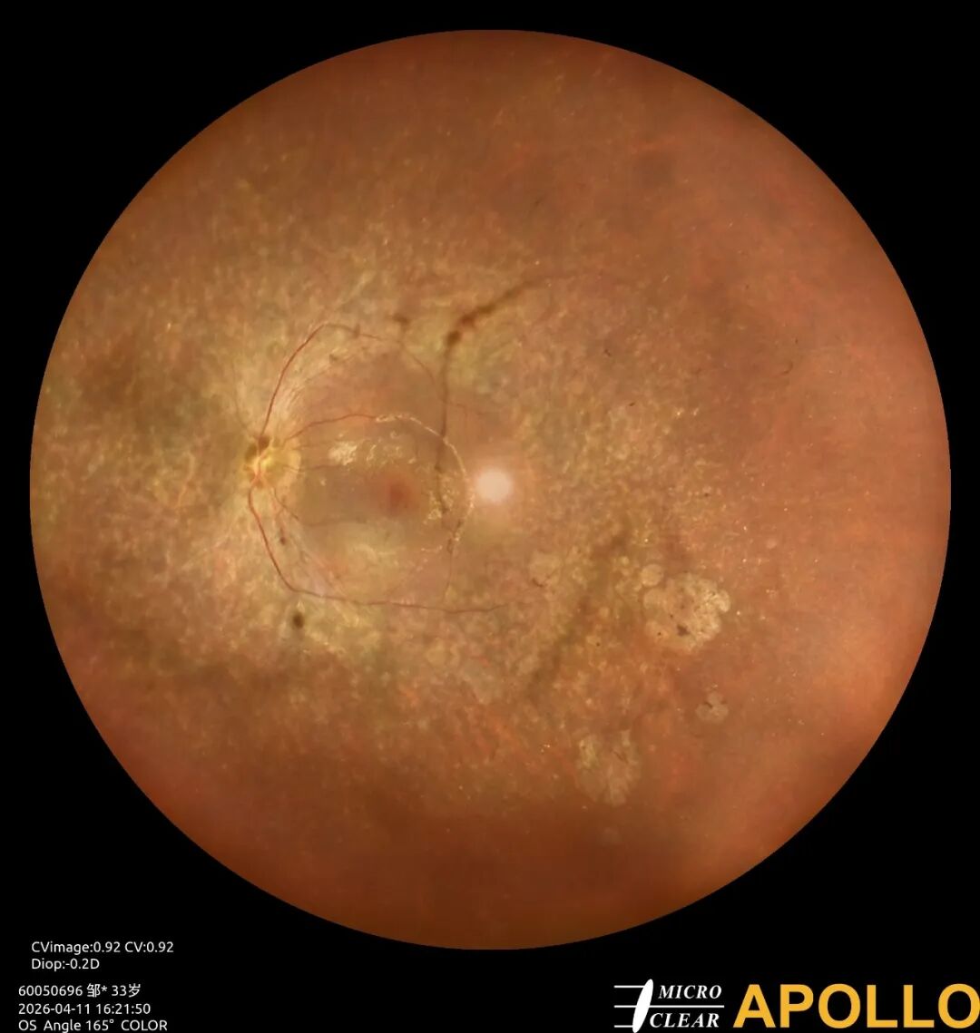 彩色眼底照相查什么眼底“侦察兵”上线！平湖一院眼科新增广角眼底激光相机_https://www.jmylbn.com_新闻资讯_第16张