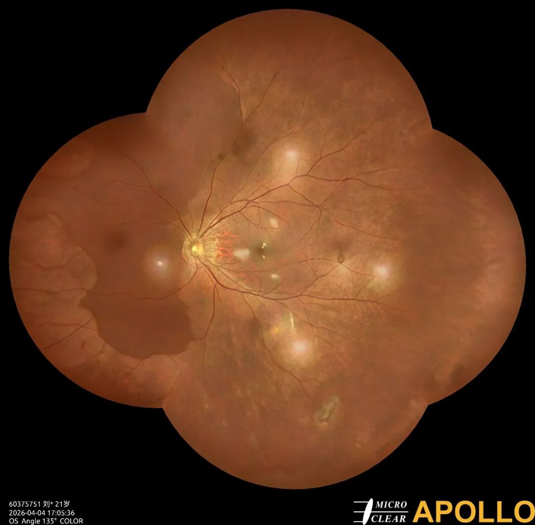 彩色眼底照相查什么眼底“侦察兵”上线！平湖一院眼科新增广角眼底激光相机_https://www.jmylbn.com_新闻资讯_第5张