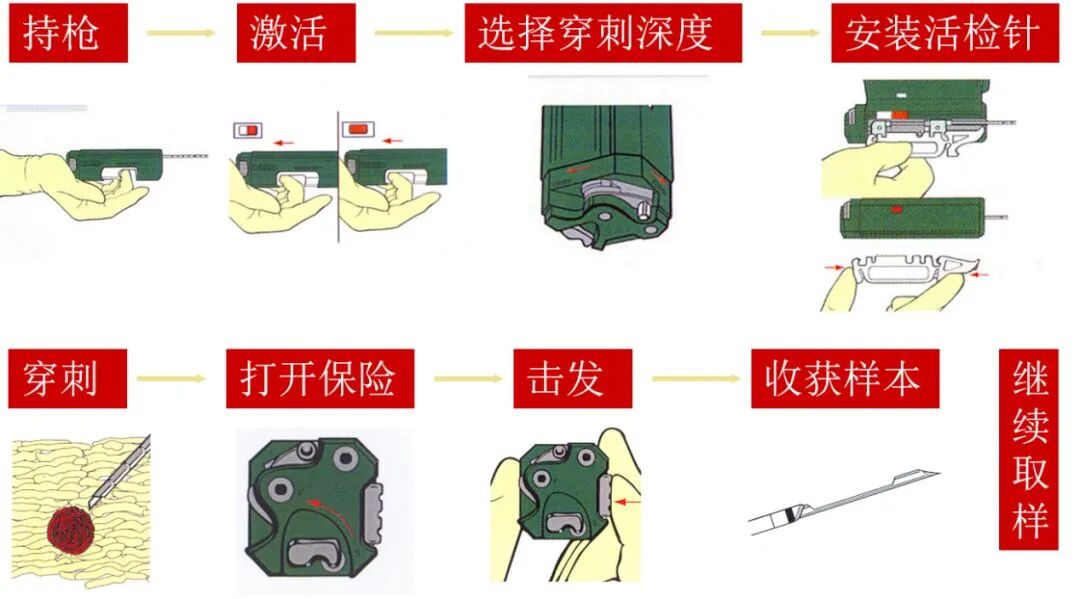 穿刺枪怎么升级肾脏穿刺活检术：入门教程_https://www.jmylbn.com_新闻资讯_第7张
