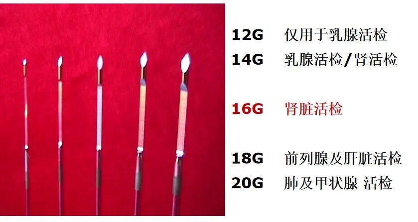 穿刺枪怎么升级肾脏穿刺活检术：入门教程_https://www.jmylbn.com_新闻资讯_第6张