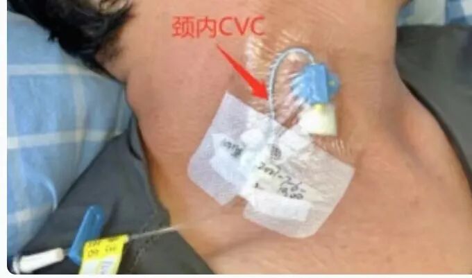 中心静脉导管是什么肿瘤化疗的“生命线”：PICC、PORT、中心静脉导管CVC分别是什么？_https://www.jmylbn.com_新闻资讯_第6张
