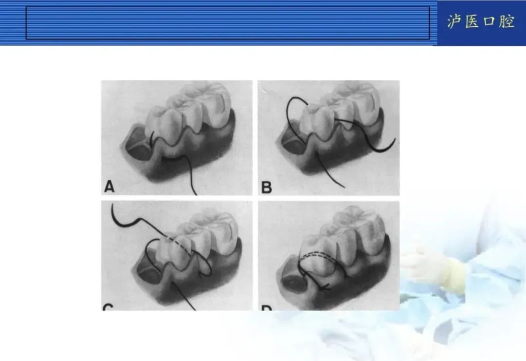 翻瓣手术如何做，看完这篇手术思路更清晰！